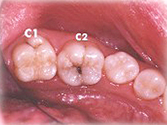 C2 ～象牙質の虫歯～