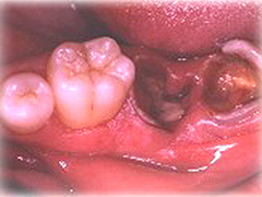 C4 ～歯根に達した虫歯～