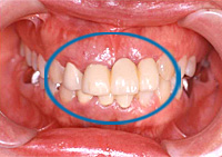 前歯のインプラント
